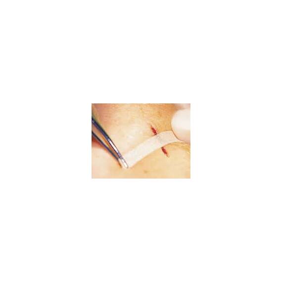 Plasture pentru inlocuirea suturilor chirurgicale  OMNISTRIP, Marime (217): 6 x 76 mm - - Roveli